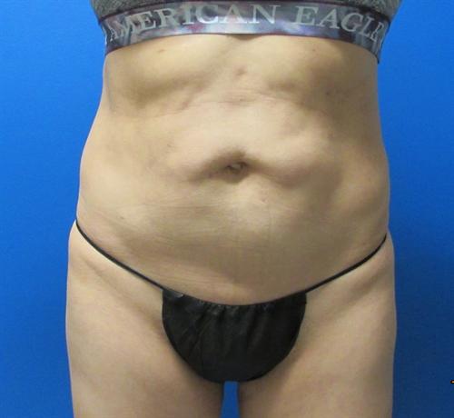 Tummy Tuck Before and After | SGK Plastic Surgery