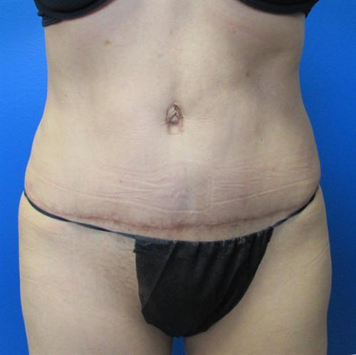 Tummy Tuck Before and After | SGK Plastic Surgery