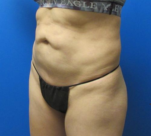 Tummy Tuck Before and After | SGK Plastic Surgery