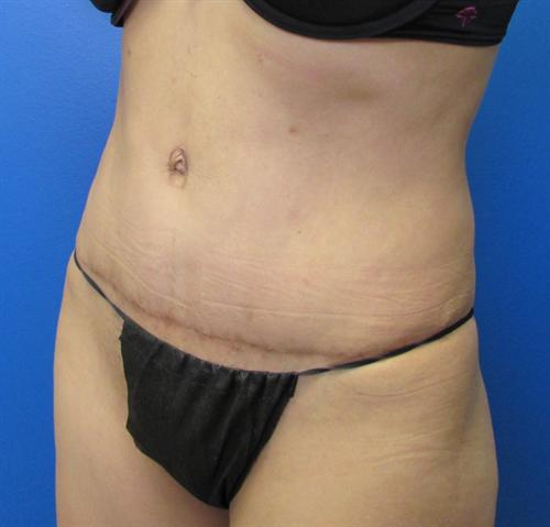 Tummy Tuck Before and After | SGK Plastic Surgery