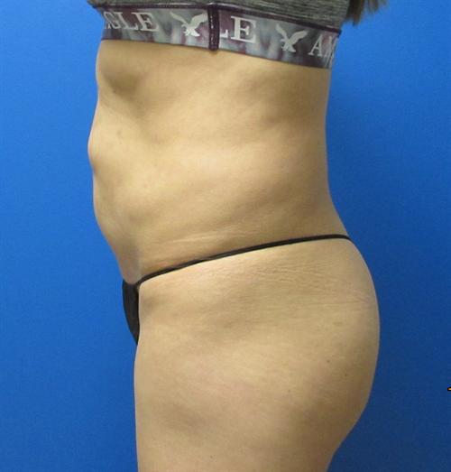 Tummy Tuck Before and After | SGK Plastic Surgery