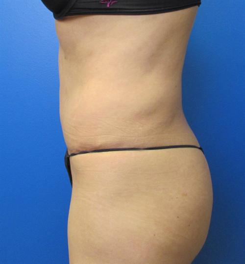 Tummy Tuck Before and After | SGK Plastic Surgery