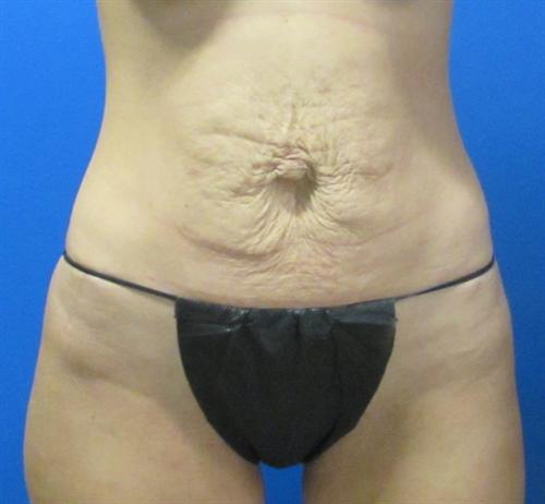 Tummy Tuck Before and After | SGK Plastic Surgery