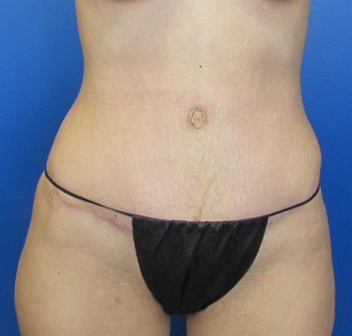 Tummy Tuck Before and After | SGK Plastic Surgery