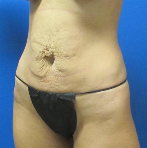 Tummy Tuck Before and After | SGK Plastic Surgery