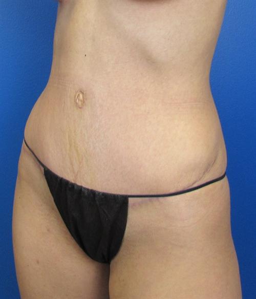 Tummy Tuck Before and After | SGK Plastic Surgery