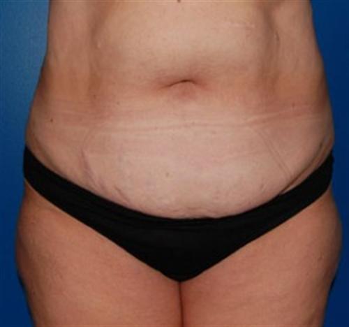 Tummy Tuck Before and After | SGK Plastic Surgery