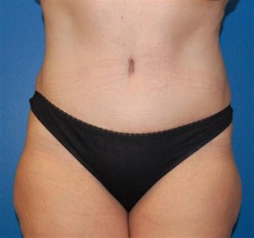 Tummy Tuck Before and After | SGK Plastic Surgery