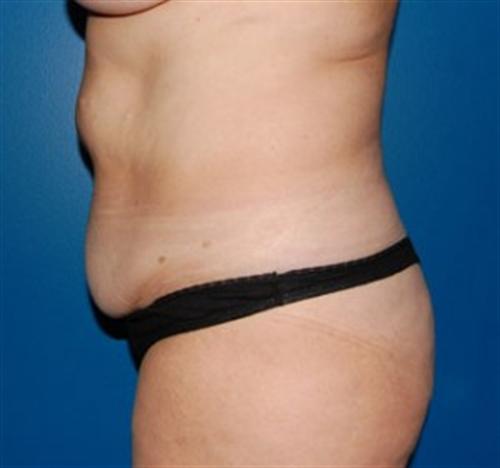 Tummy Tuck Before and After | SGK Plastic Surgery