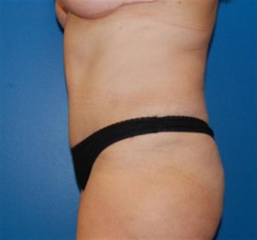 Tummy Tuck Before and After | SGK Plastic Surgery