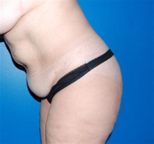 Tummy Tuck Before and After | SGK Plastic Surgery