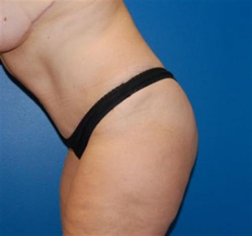 Tummy Tuck Before and After | SGK Plastic Surgery