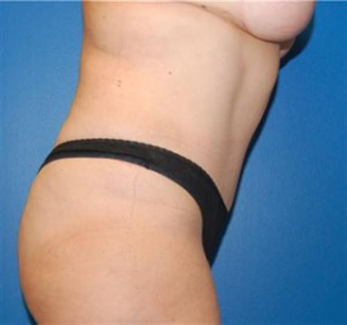 Tummy Tuck Before and After | SGK Plastic Surgery