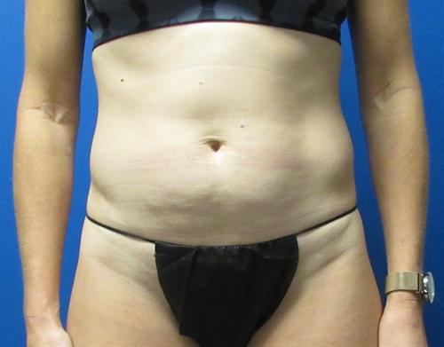 Tummy Tuck Before and After | SGK Plastic Surgery