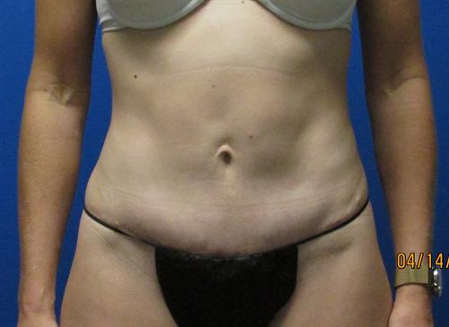 Tummy Tuck Before and After | SGK Plastic Surgery