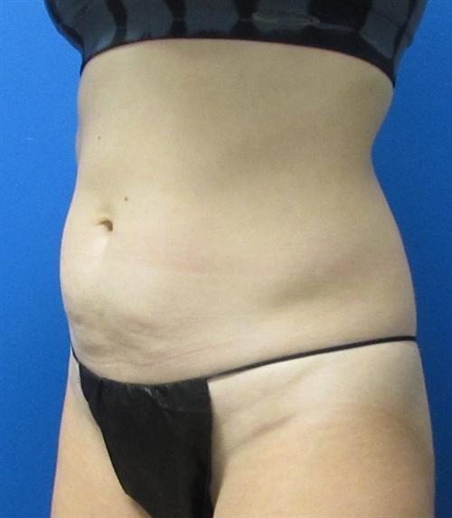 Tummy Tuck Before and After | SGK Plastic Surgery