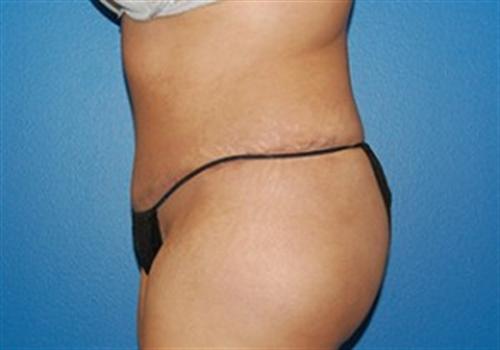 Tummy Tuck Before and After | SGK Plastic Surgery