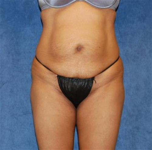 Tummy Tuck Before and After | SGK Plastic Surgery