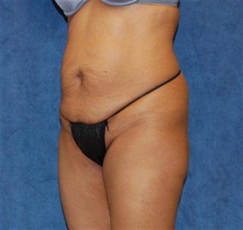 Tummy Tuck Before and After | SGK Plastic Surgery