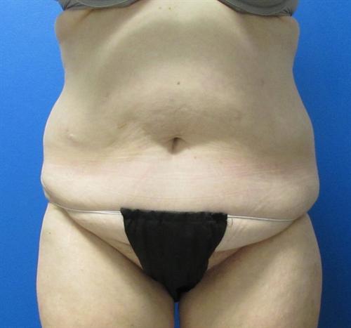 Tummy Tuck Before and After | SGK Plastic Surgery