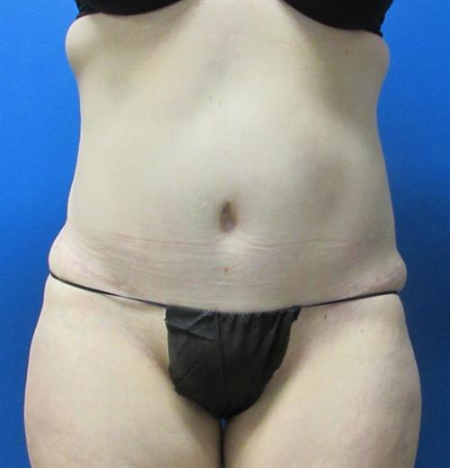 Tummy Tuck Before and After | SGK Plastic Surgery