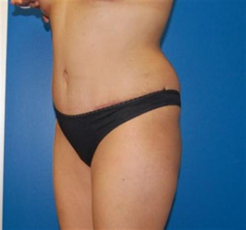 Tummy Tuck Before and After | SGK Plastic Surgery