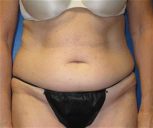 Tummy Tuck Before and After | SGK Plastic Surgery