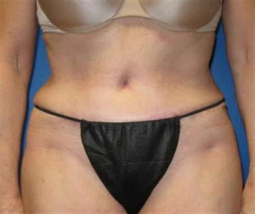 Tummy Tuck Before and After | SGK Plastic Surgery