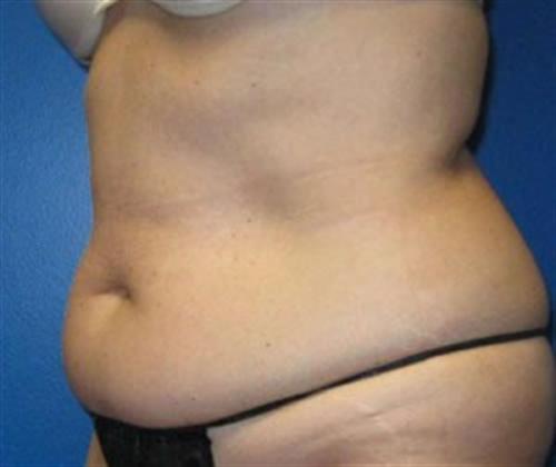 Tummy Tuck Before and After | SGK Plastic Surgery