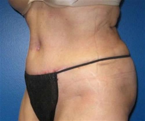 Tummy Tuck Before and After | SGK Plastic Surgery