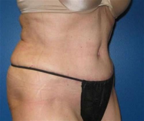 Tummy Tuck Before and After | SGK Plastic Surgery