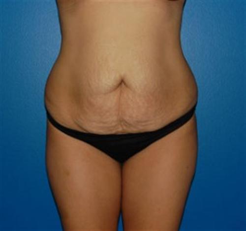 Tummy Tuck Before and After | SGK Plastic Surgery