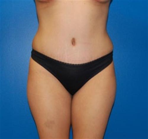 Tummy Tuck Before and After | SGK Plastic Surgery