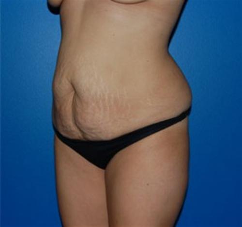 Tummy Tuck Before and After | SGK Plastic Surgery