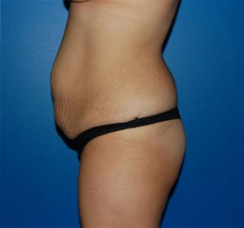 Tummy Tuck Before and After | SGK Plastic Surgery