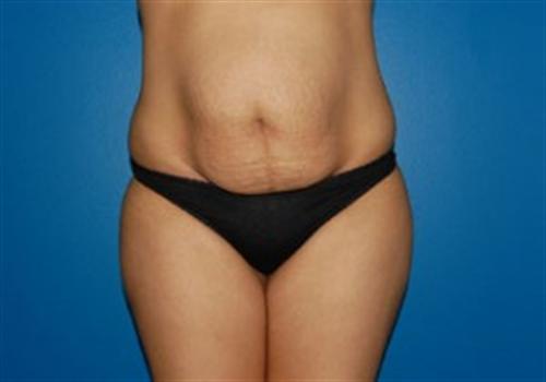 Tummy Tuck Before and After | SGK Plastic Surgery