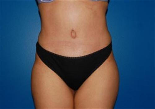 Tummy Tuck Before and After | SGK Plastic Surgery