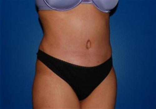 Tummy Tuck Before and After | SGK Plastic Surgery