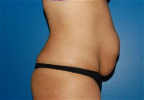 Tummy Tuck Before and After | SGK Plastic Surgery