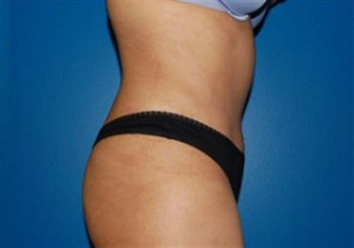 Tummy Tuck Before and After | SGK Plastic Surgery