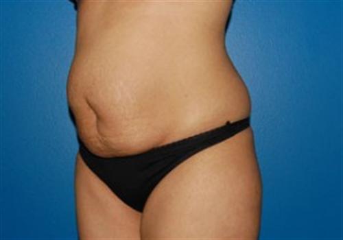 Tummy Tuck Before and After | SGK Plastic Surgery