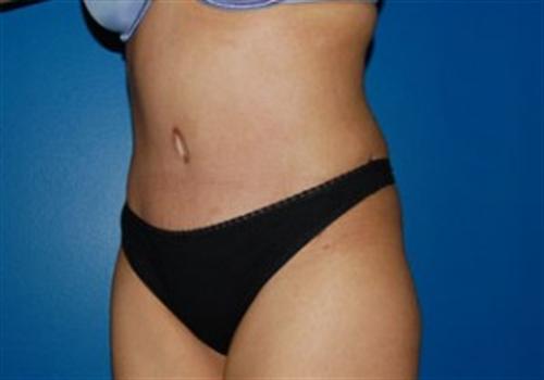 Tummy Tuck Before and After | SGK Plastic Surgery