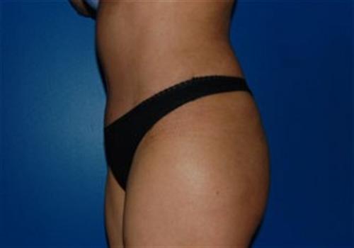 Tummy Tuck Before and After | SGK Plastic Surgery