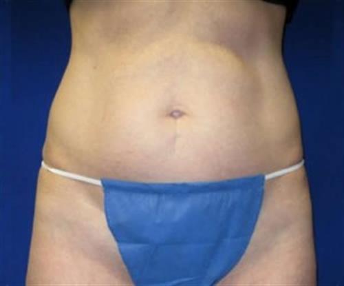 Tummy Tuck Before and After | SGK Plastic Surgery