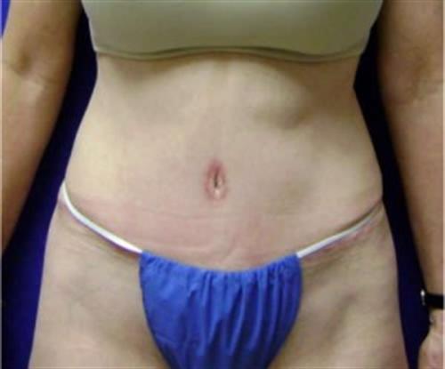 Tummy Tuck Before and After | SGK Plastic Surgery