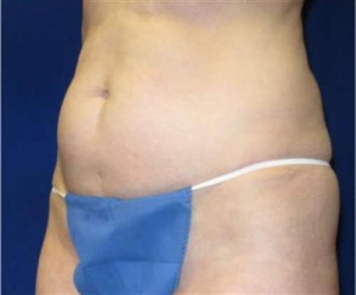 Tummy Tuck Before and After | SGK Plastic Surgery