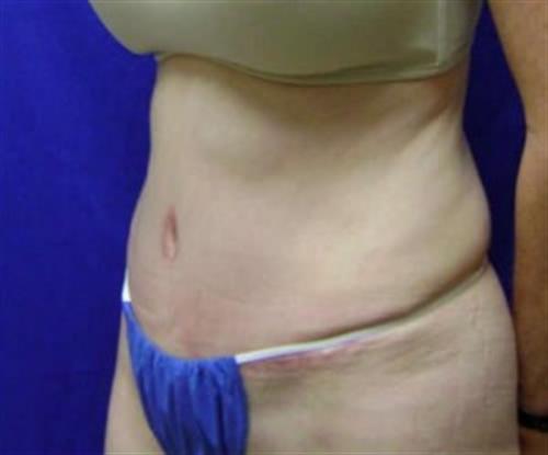 Tummy Tuck Before and After | SGK Plastic Surgery