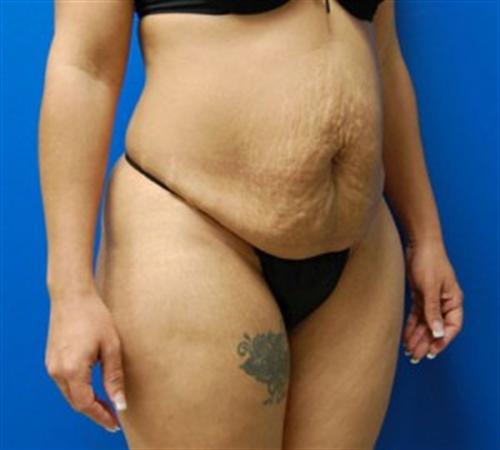 Tummy Tuck Before and After | SGK Plastic Surgery