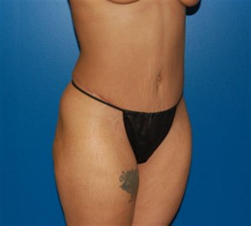 Tummy Tuck Before and After | SGK Plastic Surgery