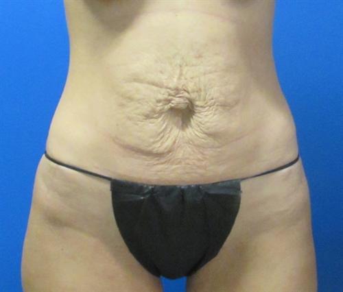 Tummy Tuck Before and After | SGK Plastic Surgery